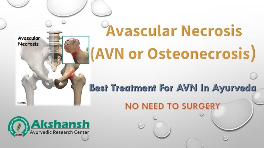 Avascular necrosis (AVN)